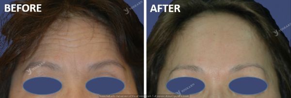 forehead lift[2].png (600×203)